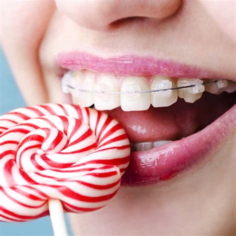 comer con brackets metalicos|Alimentos que se pueden comer con brackets .